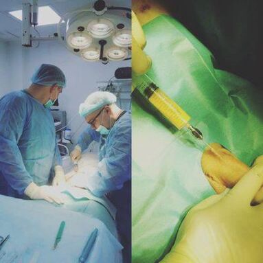 Peenise paksenemine on võimalik operatsiooni abil